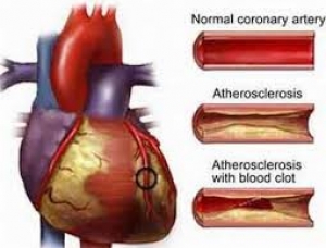Bệnh động mạch vành có nguy hiểm không?