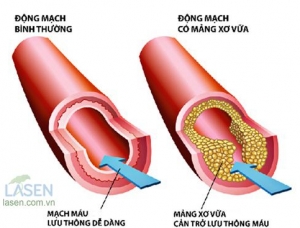 Bệnh mỡ máu là gì, bệnh mỡ máu cao có nguy hiểm không?