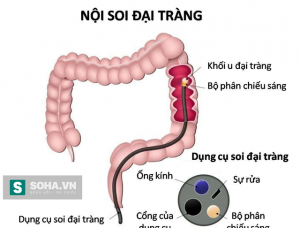 Ung thư đại trực tràng - Có triệu chứng đi khám ngay, phát hiện sớm dễ chữa khỏi