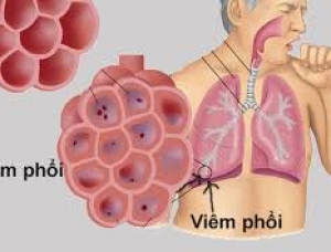 VIÊM PHỔI LÀ GÌ? ĐIỀU TRỊ VIÊM PHỔI