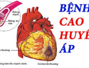 Tư vấn điều trị bệnh cao huyết áp