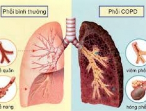 Bệnh phổi tắc nghẽn mãn tính (COPD) là gì?