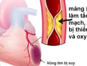 BÍ QUYẾT TRỊ THIẾU MÁU CƠ TIM