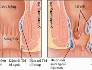 KHÁM TRĨ, DÒ HẬU MÔN MẠCH LƯƠN